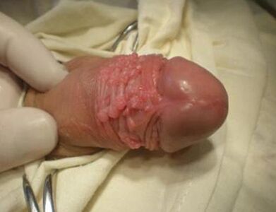 Papilloma an einem Mitglied