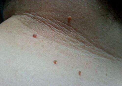 Papillome am Hals