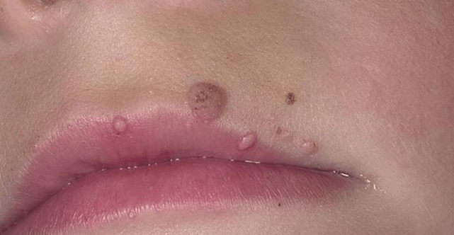 Papillome auf den Lippen